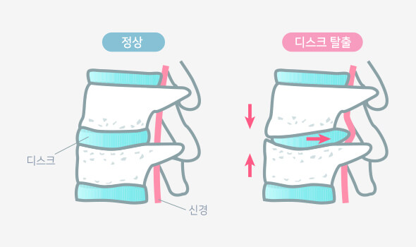 정상디스크와 디스크탈출 차이