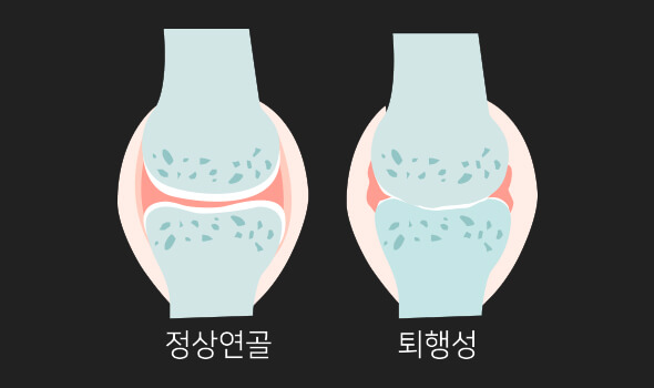 퇴행성 무릎 관절염