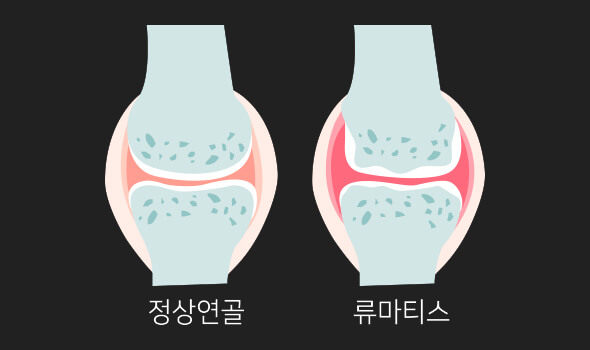 류마티스 관절염